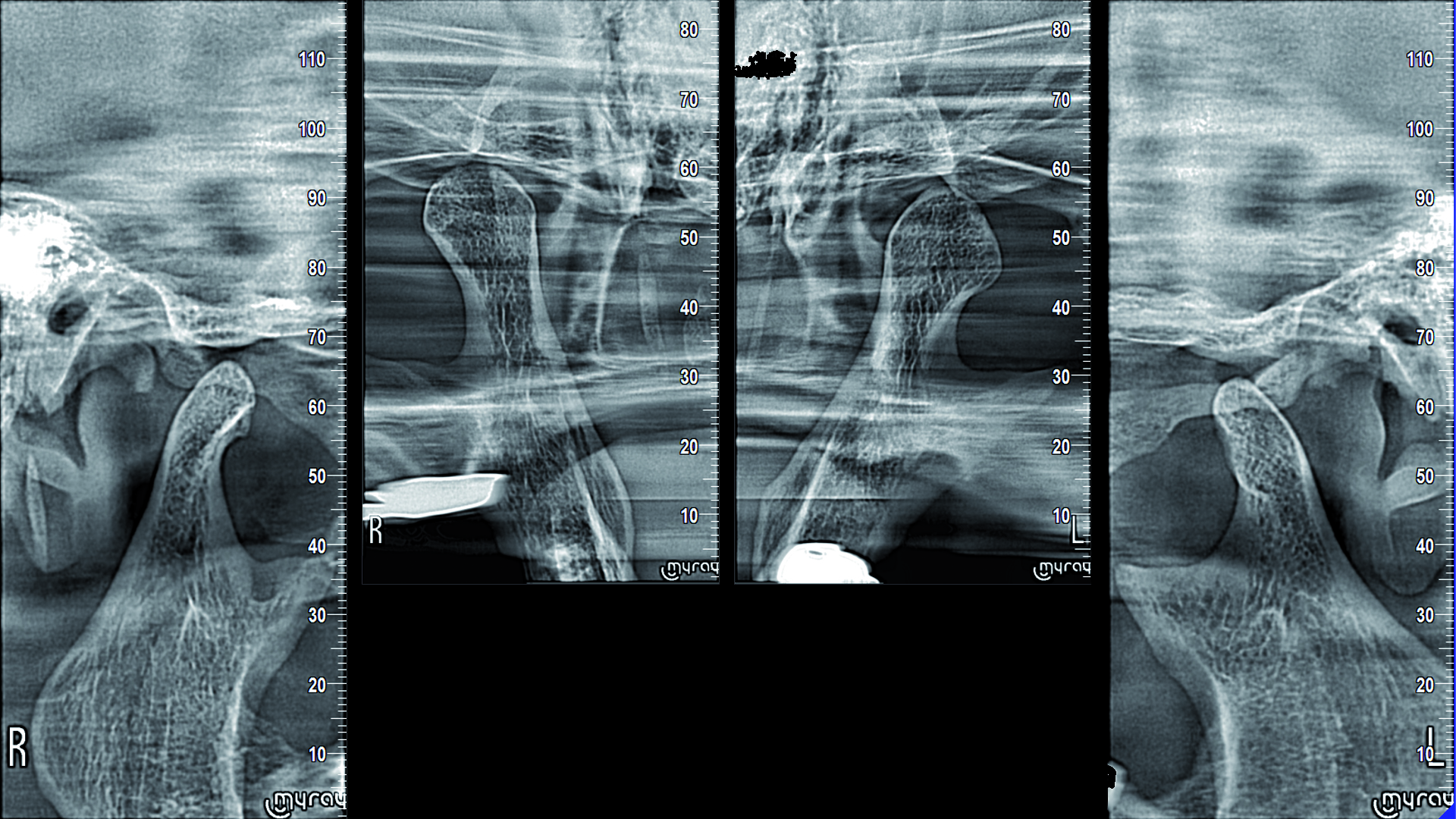 ÇENE EKLEMİ (TEMOROMANDIBULAR EKLEM) İNCELEMELERİ