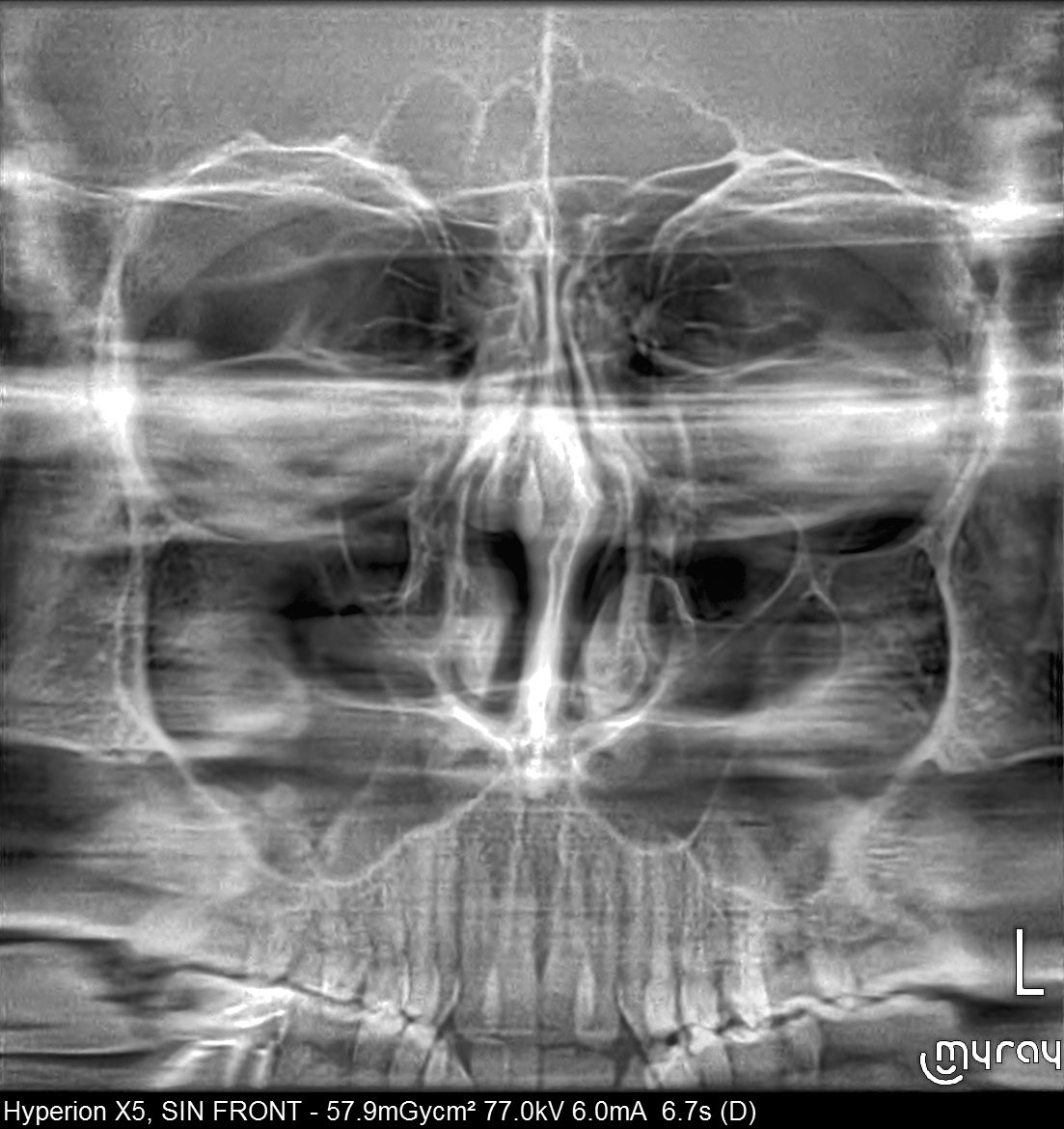 MAXILLER SINUS İNCELEMELERİ